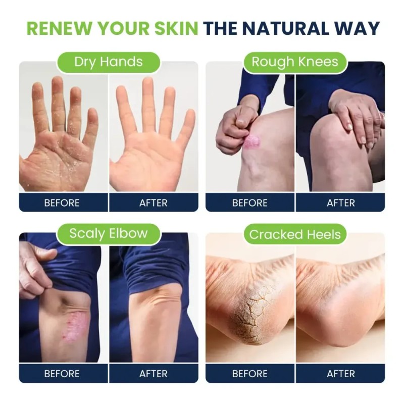 Foot Cure Crema Eliminación Talón Agrietado Picazón Y Tiña