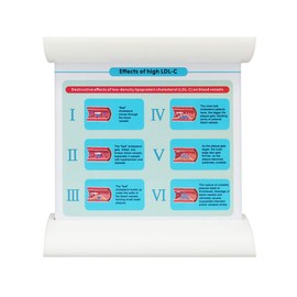 Low-Density Lipoprotein LDL Blood Vessel Model for Medical Patient Doctor Teaching