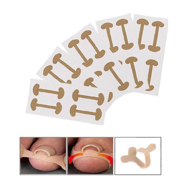 EBANKU Ingrown Toenail Treatment Strips, 20 Pcs Toe Nail Correction
