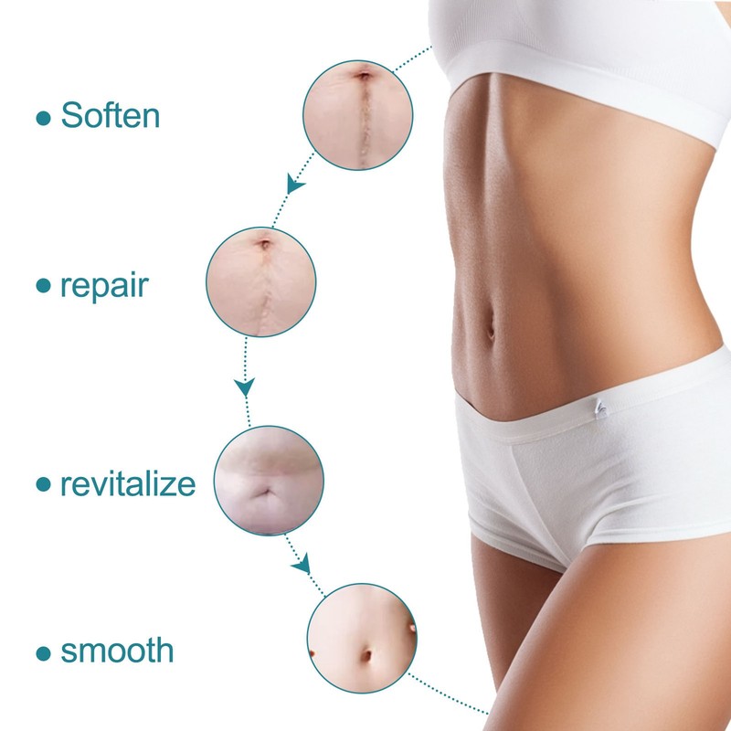 4.9ft 1.6in Scar Roll Silicone Scar Sheets Professional Scar Removal