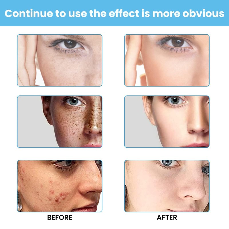 Crema para Manchas Oscuras en La Cara, Cremas para Quitar