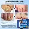 Líquido Para Hongos En Uñas - Cur-a Hongos Y Onicomicosis