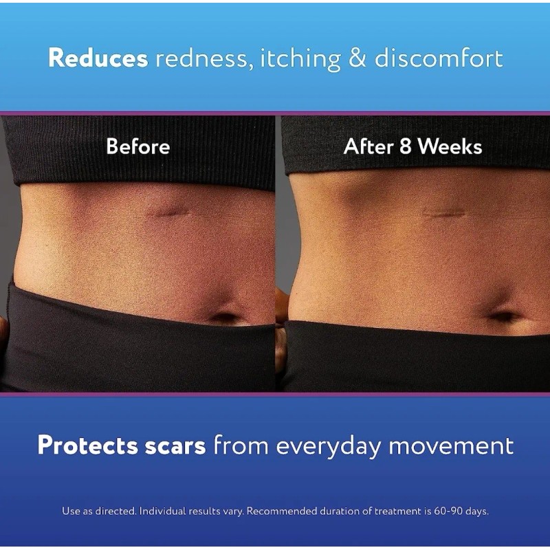 Scaraway Gel Roller Ball Para Cicatrices Queloides