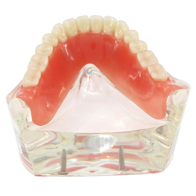 Dental Implant Teeth Restoration Model Mandibular Overdenture with 2 Implants