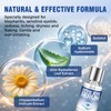 Blepharitis Treatment Serum 30ml, Natural Stye Eye Treatment with Hyaluronic