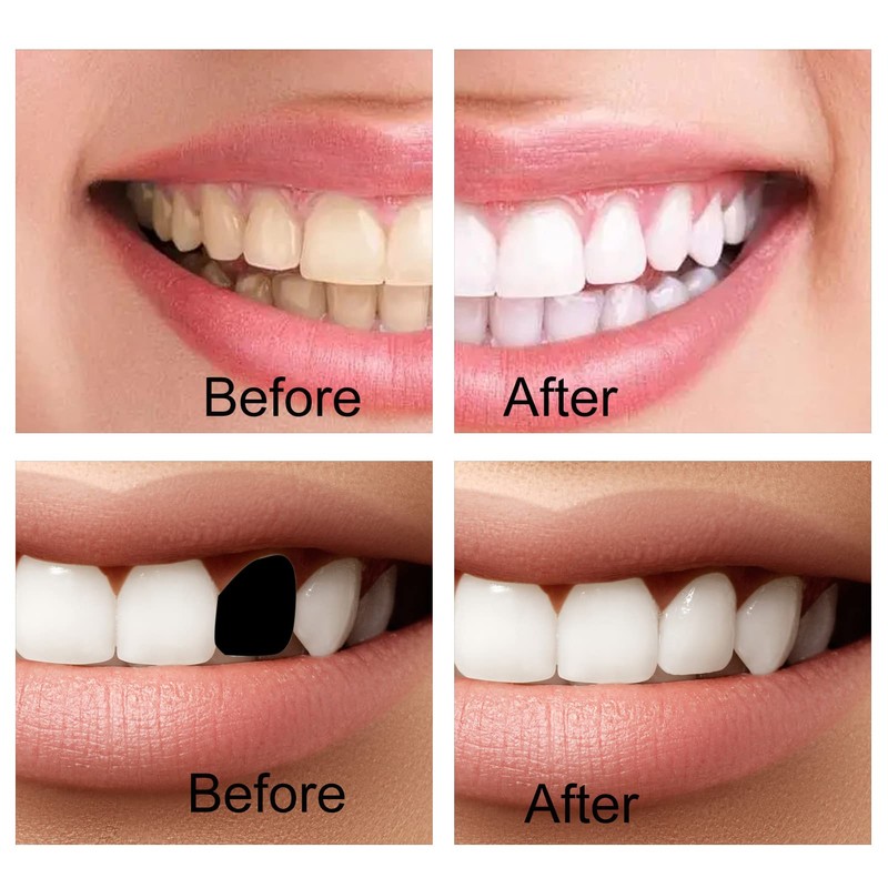 QincLing 2 Pairs of False Teeth Veneers, Temporary Teeth, Artificial