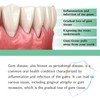 Gum Relief Drops, DentiZen Gum Regrowth Drops, Gum Treatment for