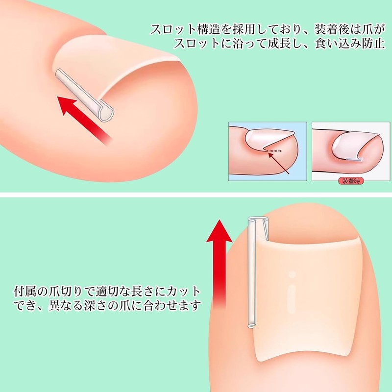 Chisafly Rolling Nail Clips, Rolling Toenails, Foot Coiled Toenails [10