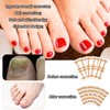 106pcs Ingrown Toenail Corrector Kit, Toenail Correction Strips Tape Ingrown