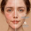 GeeRic Parches para Acné Invisibles, 180 Unidades, Hidrocoloide