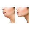Dtup Kit Reduce Papada Define Mandibula Guasha + Gel +