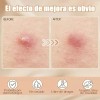 280pzs Mascarillas Estrella Acne