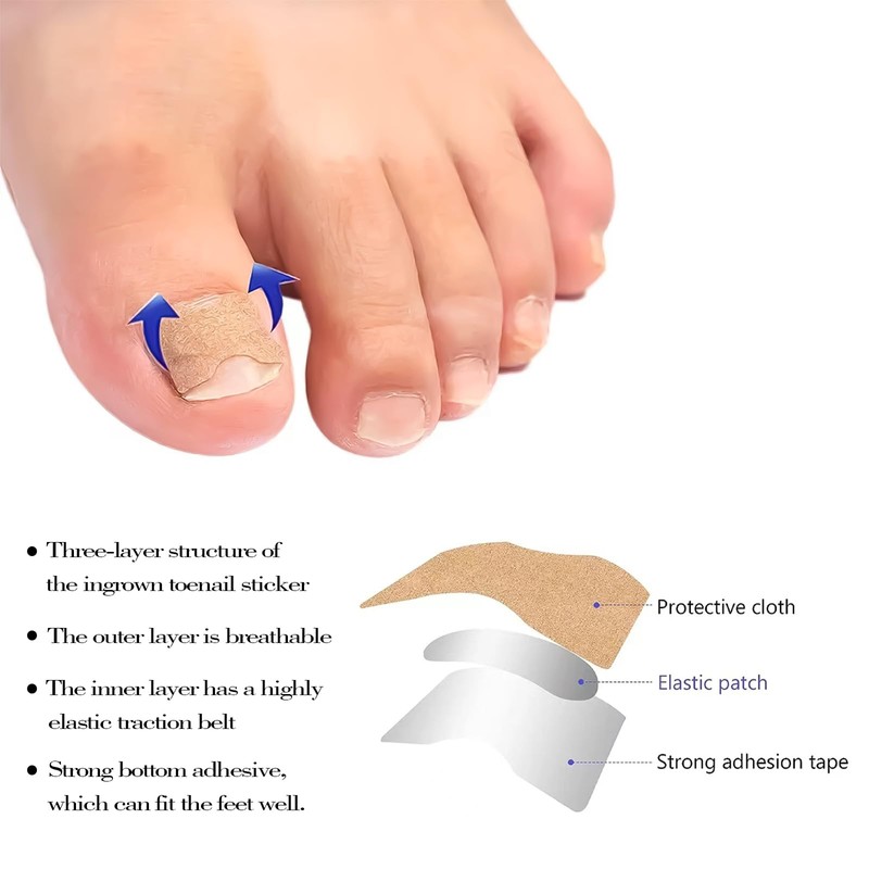 HOBKEY 140 Pieces Ingrown Toenail Stickers Correction Patches for Toenails