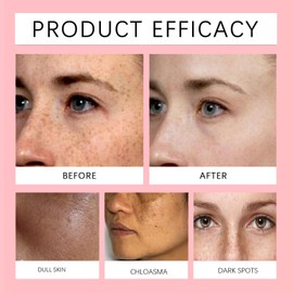 Pigmentflecken Entferner Gesichtscreme, Anti Pigmentflecken Gesicht, Dark Spot Correcting Creme mit Niacinamid, Vitamin C, Anti Aging Creme Frauen für Altersflecken, Sommersprossen, Glow Skin