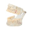 2PCS Transparent Disease Teeth Model, Dental Implant Teeth Model, Dental