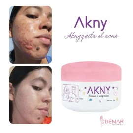 Akny Crema Para Eliminar Acné                                                                                                                         