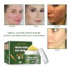 Crema De Tratamiento De Acné Con Ginseng Para Eliminar Las