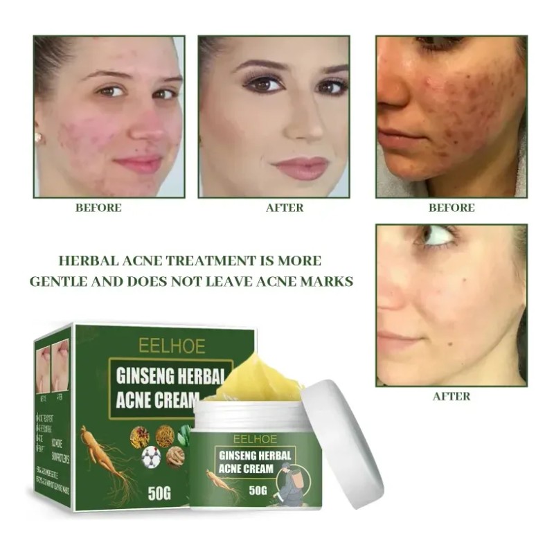 Crema De Tratamiento De Acné Con Ginseng Para Eliminar Las
