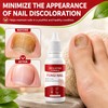 2PCS Fungi Nail ToenailTreatment,Gentle Formula,Effectively lmproves Nails for a More