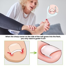 BEZOX Ingrown Toenail Corrector Set - 40 Pcs Pain-Free Toenail Straightener Strips with Toenail Lifter - Easy Use Ingrown Toenail Tools Kit