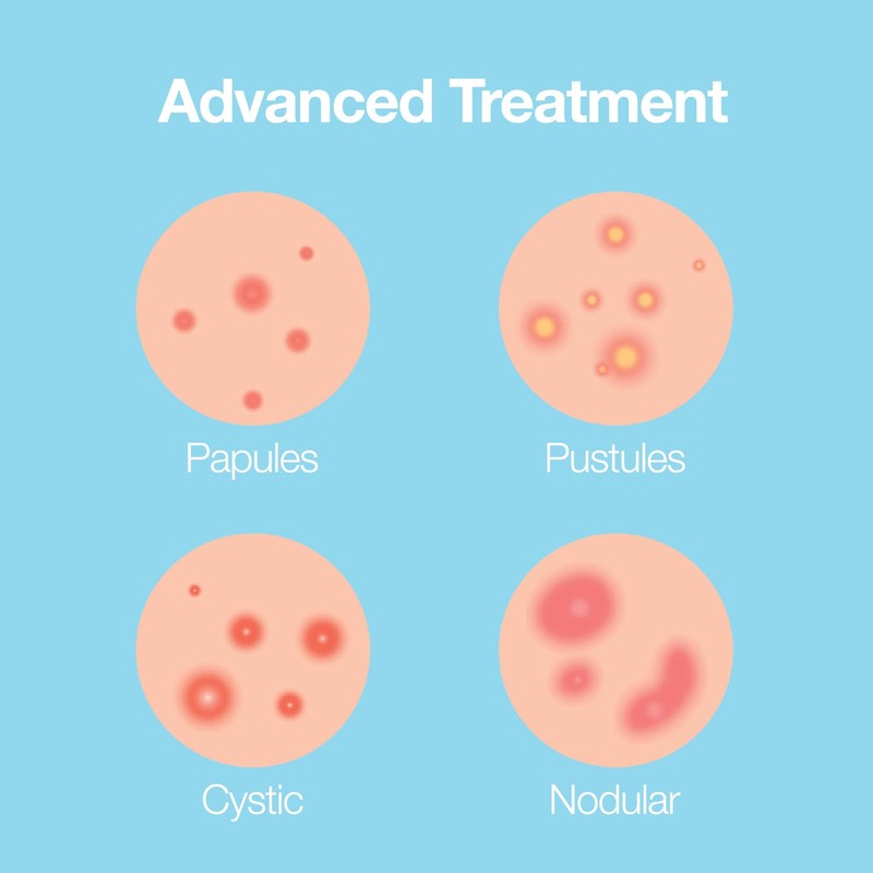 Saplaya K-Beauty Ance Care Hydrocolloid Patches For Acne Pimple Care