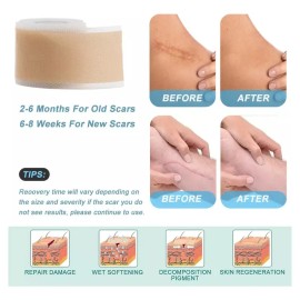 Hojas Silicona Scar Patch 4cm 300cm Cicatrices