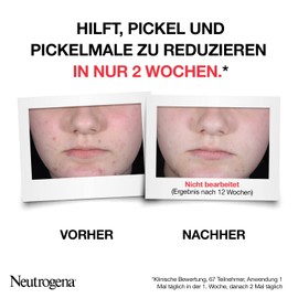 Neutrogena Anti-Pimple + Exfoliating Serum 30 ml, Skin Image Renewing Face Serum with Skin Clarifying Salicylic Acid + AHA / PHA for Blemished Skin, Visibly Reduces Pimples and Pimples in Just 1 Week*