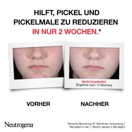 Neutrogena Anti-Pimple + Exfoliating Serum 30 ml, Skin Image Renewing Face Serum with Skin Clarifying Salicylic Acid + AHA / PHA for Blemished Skin, Visibly Reduces Pimples and Pimples in Just 1 Week*