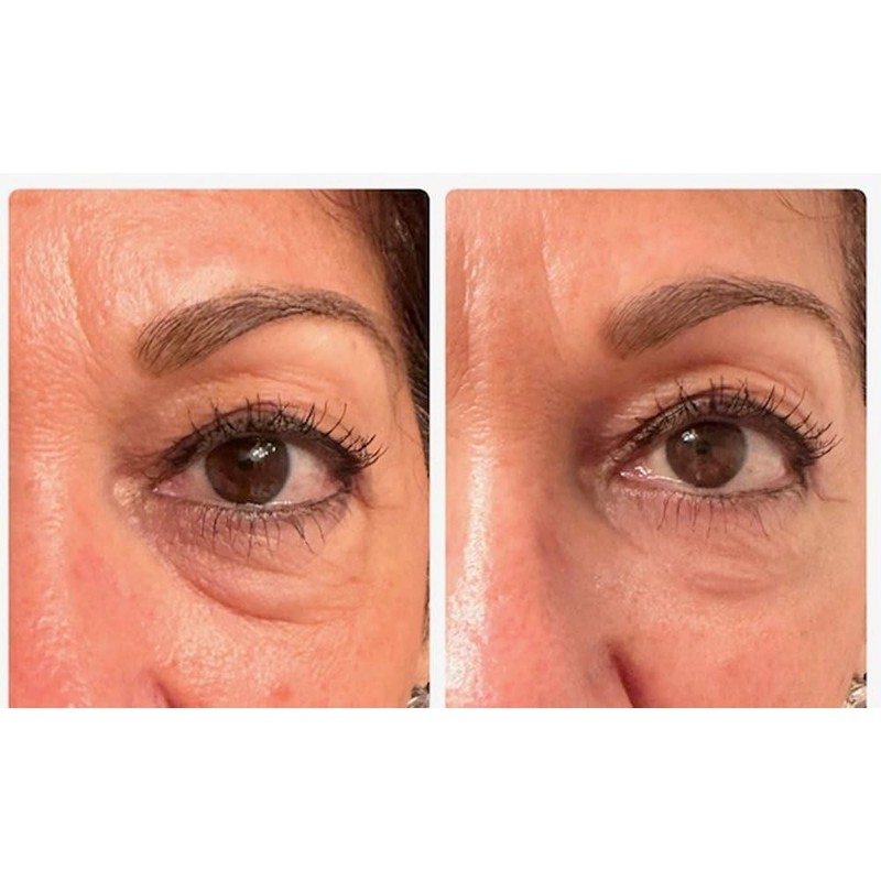 Instant Eye Bag Puffiness And Wrinkle Remover Cream For Women