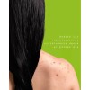 Serum Sebo, Tratamiento Control Y Eliminación Deacné.