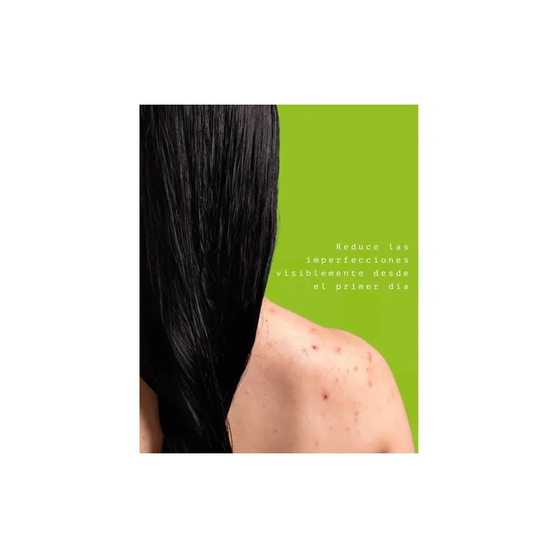 Serum Sebo, Tratamiento Control Y Eliminación Deacné.