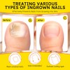 Tiras para uñas encarnadas, 60 unidades. Parche corrector de uñas