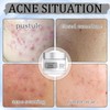 Zinksalbe gegen Pickel, mit Teebaumöl und Vitamin E, Zinksalbe Gesicht,