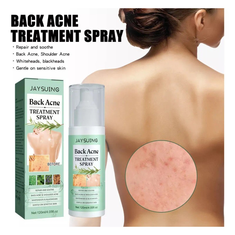 Ia Aj Cura El Acné De Espalda Con Ácido Salicílico