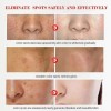 Effective Whitening Freckle Cream Remove Dark Spot Cream Removal Melanin