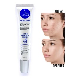 Crema Anti Acné Elimina Granos Espinillas Tratamiento 30g