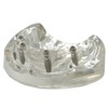 Ningfan Dental Implant Model,Implant All on 4 Overdenture Treatment Model,