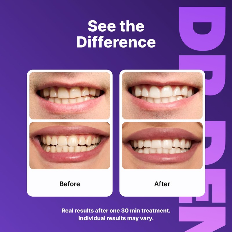 DRDENT Purple Teeth Whitening Strips 21 Treatments - Enamel Safe