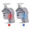 ParaTO2 Dispositivo De Avance Mandibular. Ajuste Fácil Y Múltiple