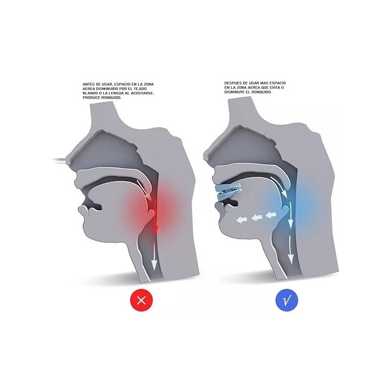 ParaTO2 Dispositivo De Avance Mandibular. Ajuste Fácil Y Múltiple