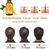 Tratamiento de pérdida de cabello Esencia de crecimiento del cabello