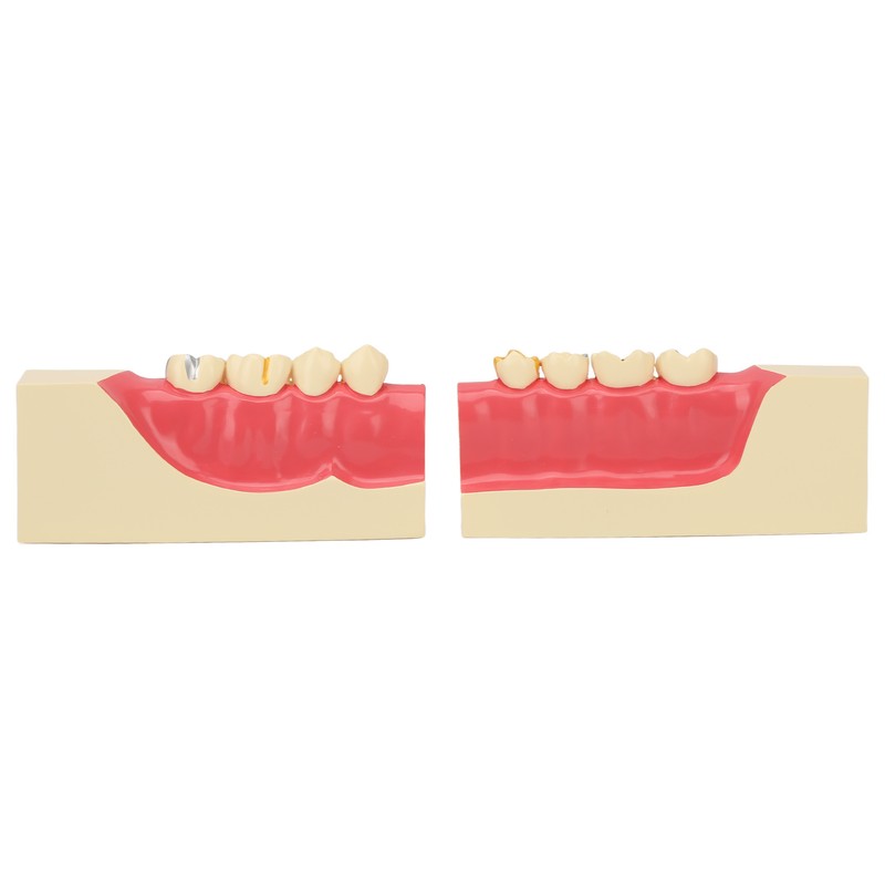 Right Lower Posterior Tooth Model 2X Magnification Detachable Resin Tooth