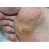 Hand & Foot Cream+ for Deep Cracked Heels, Fungal Conditions