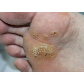 Hand & Foot Cream+ for Deep Cracked Heels, Fungal Conditions and Verrucae by Vitali-Chi 100ml