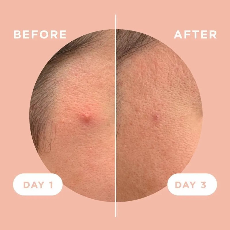 Zitsticka Killa. Parches Para Espinillas, Paquete De 8