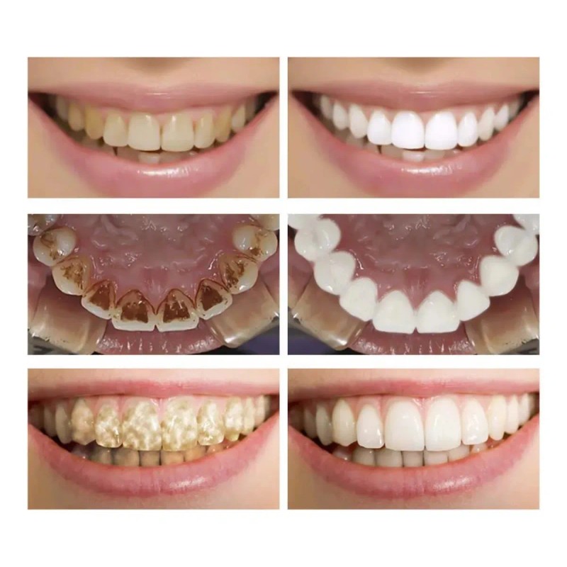 2 Esencia Blanqueadora Dental Suero Limpieza Higiene Bucal F