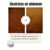 Crema De Caléndula. Regeneradora De Estrías Y Cicatrices.