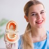 Dental Caries Teaching Model 1:1 Adult Life Size - Non-Removable