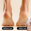 3-Piece Egg-Shaped Foot Files, Exfoliating Foot Rub, Manual Foot Scrub,