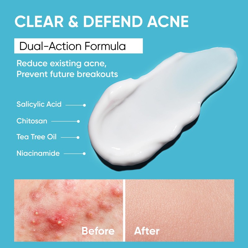 Butt Acne Clearing Treatment Cream: Clears & Prevents Breakouts Fast
